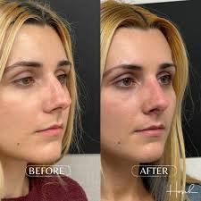 Only 1 month post op from a Minimally Invasive Surgical Rhinoplasty by Dr.  Hosch 👏 Her nose is already looking absolutely stunning!