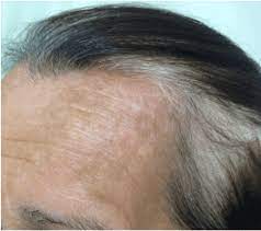 Vitiligo can affect any area of skin, but it commonly happens on the face, neck and hands, and in skin creases. Vitiligo As A Consequence Of The Use Of Diphencyprone In The Treatment Of Alopecia Areata