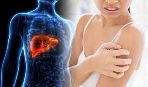 Home/ disease prevention/what are the warning signs of liver cancer? Liver Cancer Symptoms Signs Include Itchy Skin Caused By Jaundice Express Co Uk