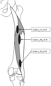 Also on lateral collateral ligament and lateral tibial condyle. Examples Of Codifications For Biceps Femoris Long Head Bflh Indirect Download Scientific Diagram