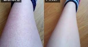 الوصفة القنبلة للتخلص من الحبوب والشعر تحت الجلد في الساقين والذراعين بسم الله الرحمان الرحيم الوصفة القن ingrown hair ingrown hair treatment strawberry legs