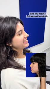 Resultados de Rinoplastia en 2 Semanas: Dr. Cazarez