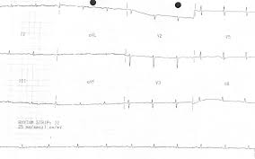 Image result for Restrictive Cardiomyopathy