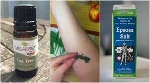 13 Home Remedies To Get Rid Of Eczema That Really Work