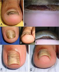 Image result for Onycholysis feet