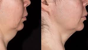 Even if you have to age, you don't have to look like you've been injecting drano into your. Clevens What To Do About That Turkey Neck