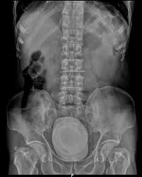Bladder Calculus Radiology Case Radiopaedia Org
