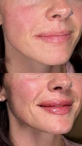 The power of facial balancing 🪄 , We are obsessed with this  transformation. Stay tuned to see the full breakdown of everything this  beauty had enhanced to achieve these subtle, but powerful changes., ...