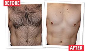 Once hard, the cloth strip is quickly pulled off. Hair Free Hair Remover Permanently Remove Unwanted Hair Unwanted Hair Removal Hair Removal Permanent Back Hair Removal