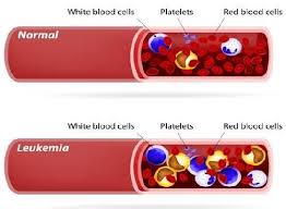In many cases, the cause of leukemia is not known. Leukemia Symptoms Causes And Treatment