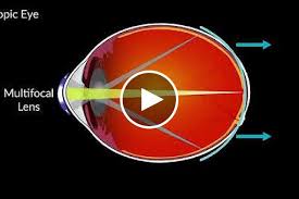 So, how long does it take? Multifocal Contact Lenses Slow Myopia Progression In Children National Institutes Of Health Nih