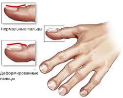 Mukoviscidóza) je autozomálně recesivní duktivní kašel, pískoty, hyperinflace, paličkovité. Mukobovydosis Symptomy A Priznaky U Deti Foto Co Vyzera Ako Fibroza