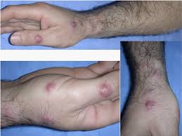 Sporotrichosis is a disease caused by the infection of the fungus sporothrix schenckii. Cutaneous Nocardiosis