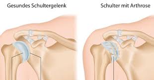 Arthrose Verhindern Erkennen Und Richtig Behandeln