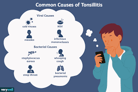 Causes Diagnosis And Treatment Of Tonsillitis