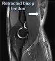 Distal bicep tendon strain treatment Sydney