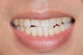 We did not find results for: Chipped Tooth What To Do Right Away Updated For 2021