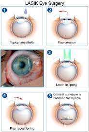 The Greatest Wealth Is Health So Take Proper Care Of Your Eyes It S The Only Place You Have To Live In Visit Our Websit Lasik Eye Surgery Lasik Surgery Lasik