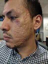 Important in the development of bones and teeth; Kale Acne Reddit