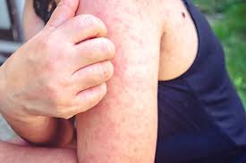 Image result for measles