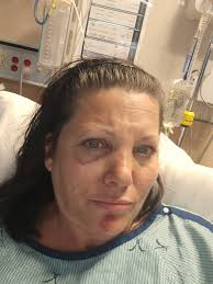 Recovering from fractured rib and strained muscles