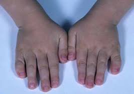 Check spelling or type a new query. Aarskog Scott Syndrome Medlineplus Genetics