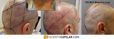 While the hair growth rate and total hair number were not improved significantly, a noticeable improvement in hair thickness was seen at 24 weeks a common problem that hair loss sufferers have with scalp massage is that it seems too easy. Hair Transplant Using Body Hair Bht Injertocapilar Com