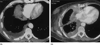 Can you educate me on a pet/ct scan issue for lung cancer? 29 28 Axial Ct Scan Of A Patient With A Right Sided Mesothelioma Download Scientific Diagram