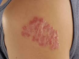 Its name comes from a distinctive pattern seen on a chest radiograph of many tiny spots distributed throughout the lung fields with the. Tuberculosis Cutis Cutane Tuberculose Tbc