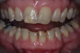 We did not find results for: Before And After Dental Bonding Photos Cosmetic Bonding Dentists