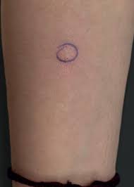 Scielo Brasil Autoimmune Progesterone Dermatitis Manifesting As Generalized Fixed Drug Eruption Autoimmune Progesterone Dermatitis Manifesting As Generalized Fixed Drug Eruption