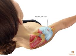 Image result for Rotator Cuff Injury