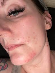 How to avoid acne after face waxing?