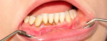 Will i have advance notice that my braces are going to come off? How To Remove Tartar From Teeth Eagle Harbor Dentist