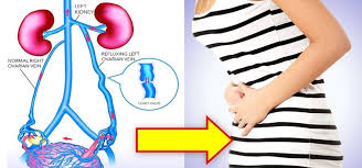 Pelvic Congestion Syndrome Treatment Ircc Pakistan