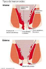 El color que queda en la zona del ano por una trombosis hemorroidal externa es violáceo y negruzco. Que Es Una Trombosis Hemorroidal Interna Trombosis Hemorroidal Que Es Sintomas Y Causas