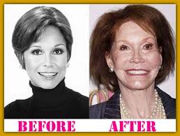 Mary Tyler Moore Plastic Surgery Turned To The Worse Bad Celebrity Plastic Surgery Celebrity Plastic Surgery Plastic Surgery
