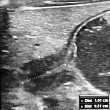 Webmd describes what happens during an ultrasound, what types of ultrasounds are used, and more. Cervix Sign Chps Stenosis Radiology Ultrasound Sonography
