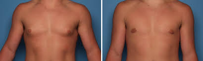 Image result for Gynecomastia