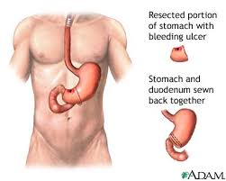 Image result for blood in stool human poop