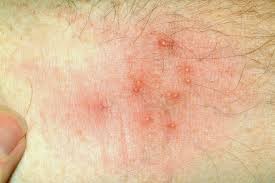 Oral antihistamines and cortisone ointments may also be helpful. Bed Bug Bites Vs Mosquito Bites Everything You Need To Know