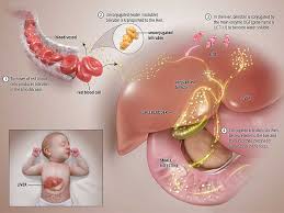 Crigler Najjar Syndrome American Liver Foundation