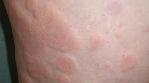 Hives are the welts, or wheals, that people get when they have urticaria. Chronic Idiopathic Urticaria Pictures Symptoms And Treatment