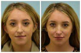 This 24 Year Old Woman Is Shown Before And After Lip Enhancement With Juvederm Dr Lam Offers Completely Painless Facial Plastic Lip Augmentation Lip Implants