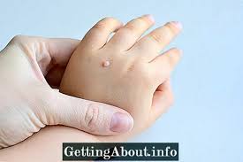 Berbanding ketuat bahagian lain, ketuat di tapak kaki biasanya sakit esp masa nak memijak ketuat atau viral warts sangat mudah berjangkit dan merebak melalui sentuhan atau contact. Ketuat Pada Bayi Punca Rawatan Rawatan Dan Pencegahan Healths 2021