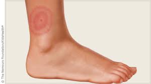 Image result for bullseye type rash