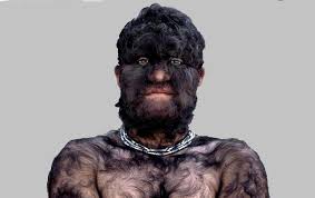 More than a dozen children in spain have been diagnosed with werewolf syndrome after an error. Let S Understand Hypertrichosis The Werewolf Syndrome Hair Skin Care