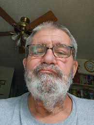 First fall after amputation experience