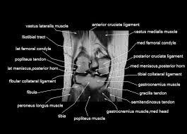 There is a flat area of tendon originating from the knee. Knee Anatomy Mri Knee Coronal Anatomy Free Cross Sectional Anatomy Knee Mri Mri Anatomy