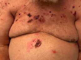 Image result for Pemphigoid